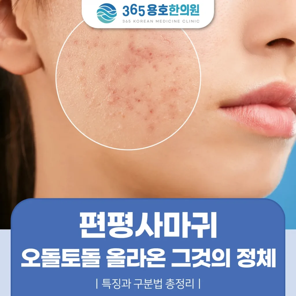 편평사마귀, 오돌토돌 올라온 그것의 정체 — 특징과 구분법 총정리
