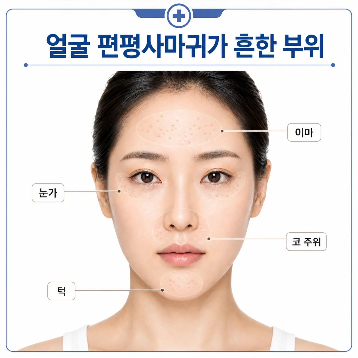 얼굴 편평사마귀가 흔히 생기는 이마 턱 코 주위 부위 그림