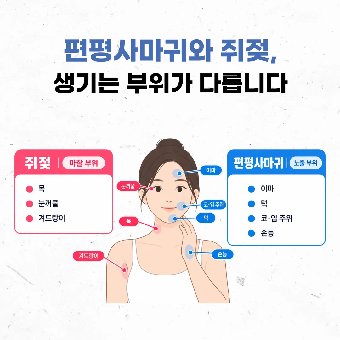 쥐젖이 잘 생기는 마찰 구역과 편평사마귀가 잘 생기는 노출 구역을 나눈 도식