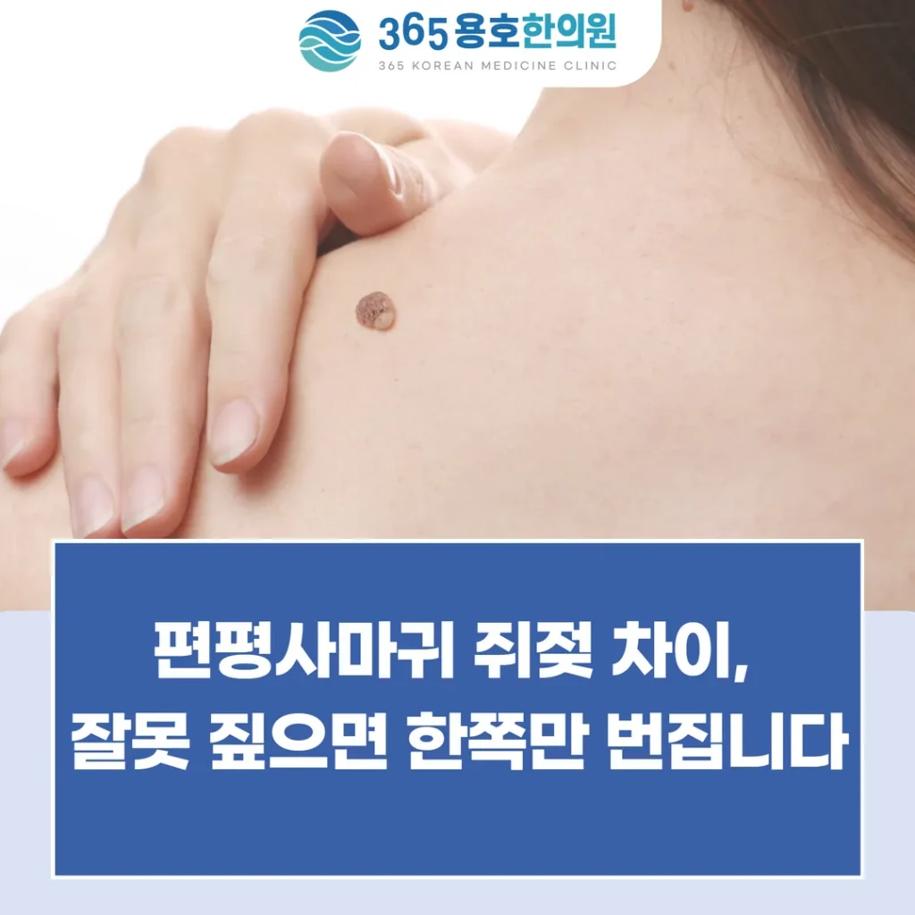 편평사마귀 쥐젖 차이, 잘못 짚으면 한쪽만 번집니다