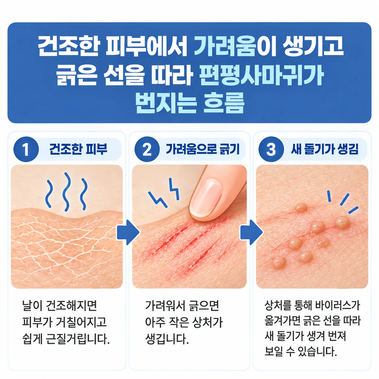 건조한 피부의 가려움과 긁기로 편평사마귀가 번지는 흐름 개념도