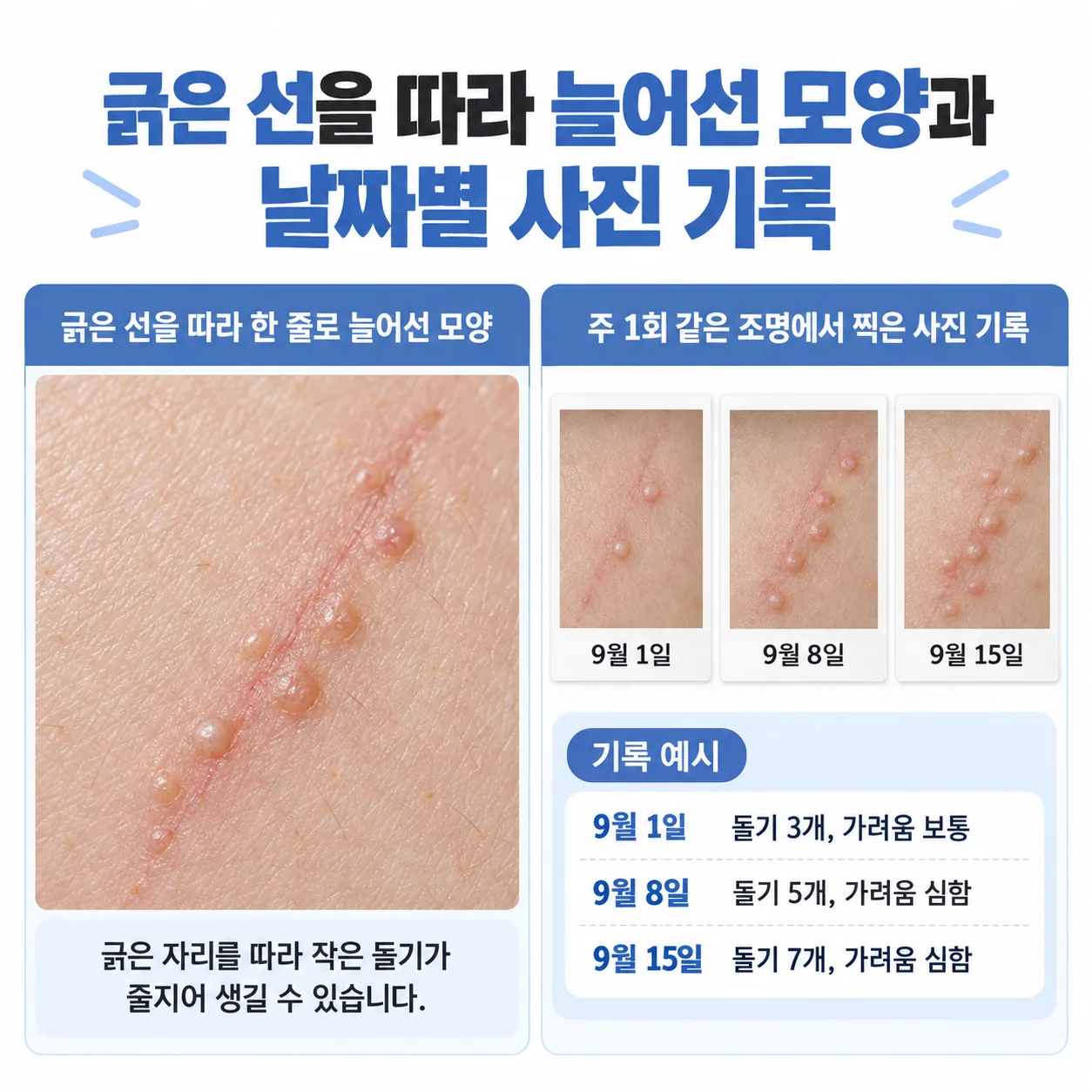 긁은 선을 따라 줄지어 생긴 편평사마귀 모양과 날짜별 사진 기록 예시